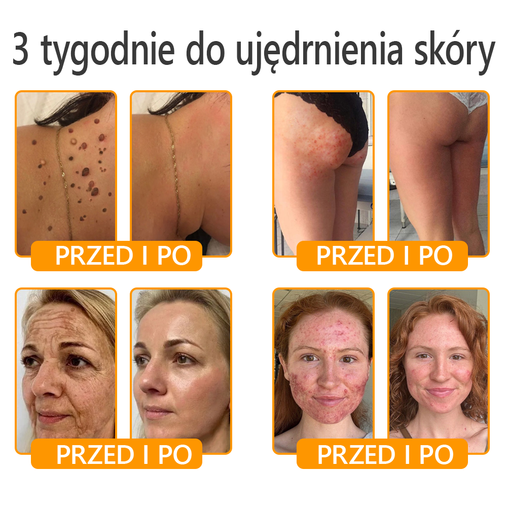 🍯 🎁 Zostało tylko 5 ostatnich pudełek! Przez ograniczony czas, dodatkowe 50% zniżki! Złap szansę na odnowę swojej skóry ✨Jeśli przegapisz teraz, nie będziesz mieć okazji do przyszłego roku!