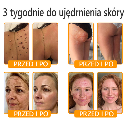 🍯 🎁 Zostało tylko 5 ostatnich pudełek! Przez ograniczony czas, dodatkowe 50% zniżki! Złap szansę na odnowę swojej skóry ✨Jeśli przegapisz teraz, nie będziesz mieć okazji do przyszłego roku!