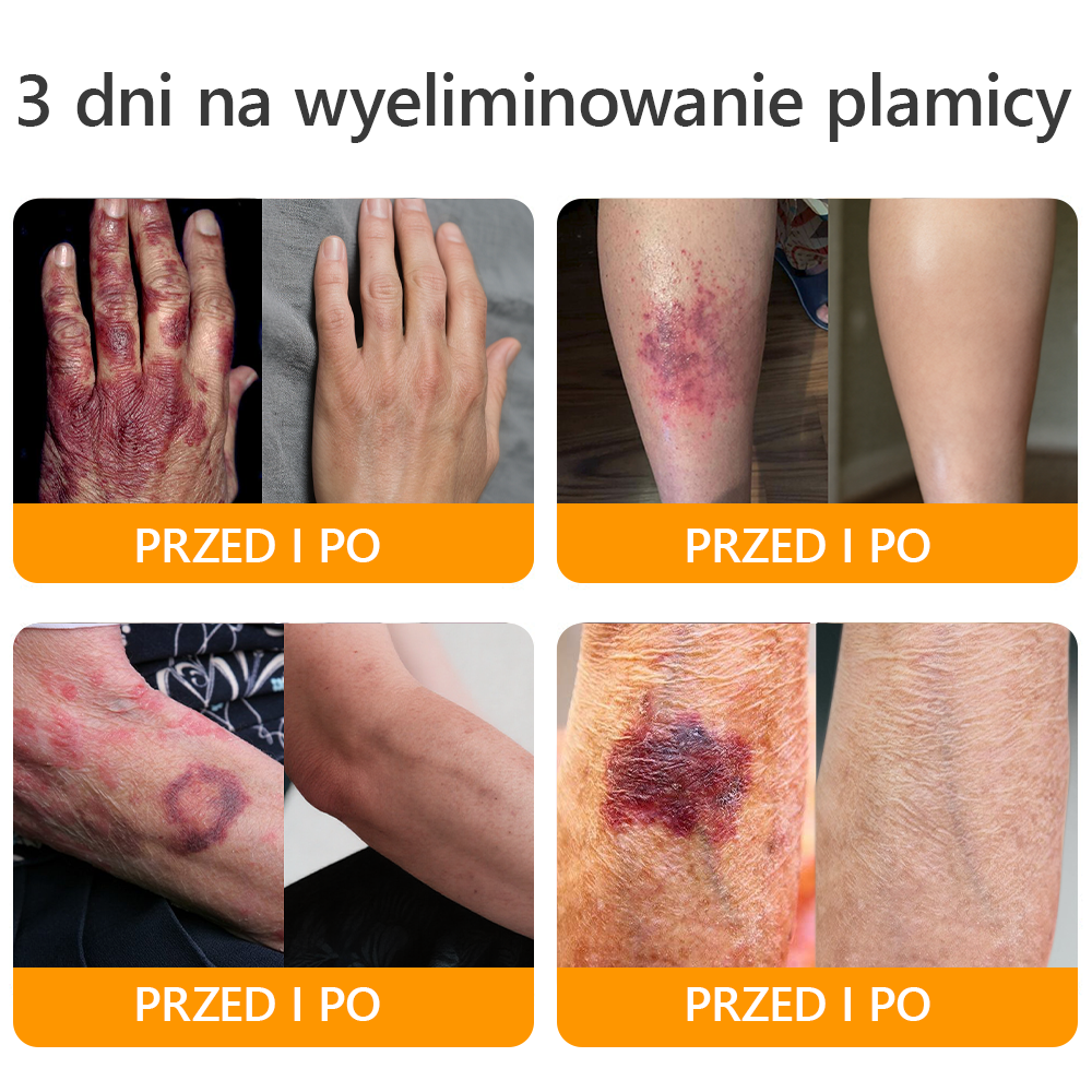🍯 🎁 Zostało tylko 5 ostatnich pudełek! Przez ograniczony czas, dodatkowe 50% zniżki! Złap szansę na odnowę swojej skóry ✨Jeśli przegapisz teraz, nie będziesz mieć okazji do przyszłego roku!