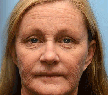 🍯 🎁 Zostało tylko 5 ostatnich pudełek! Przez ograniczony czas, dodatkowe 50% zniżki! Złap szansę na odnowę swojej skóry ✨Jeśli przegapisz teraz, nie będziesz mieć okazji do przyszłego roku!